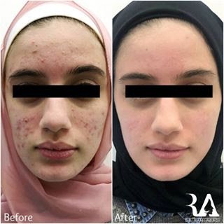 Acne Treatment