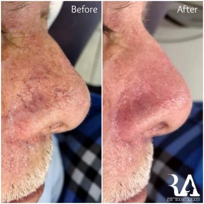 Vein Removal with Laser