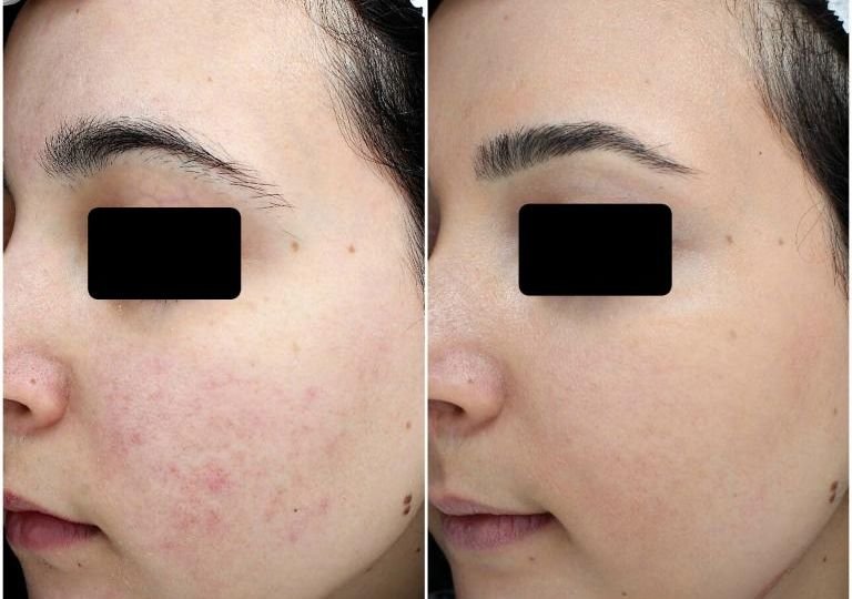 Rosacea Treatment