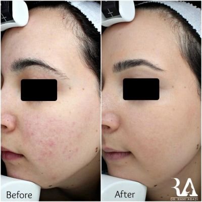 Rosacea Treatment
