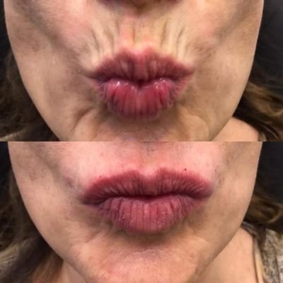 Fillers for Smoker Lines