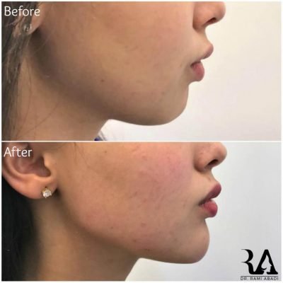 Chin Enhancement and Jawline Definition with Fillers