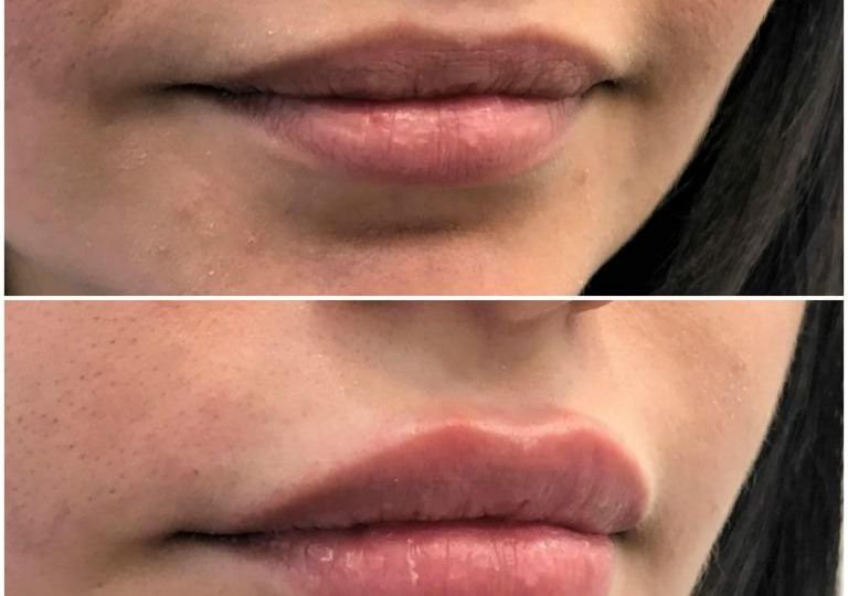Lip Enhancement with Fillers