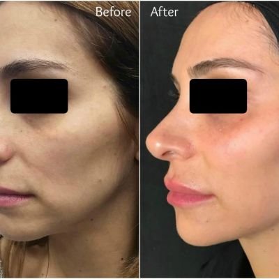 Chin Enhancement and Jawline Definition with Fillers