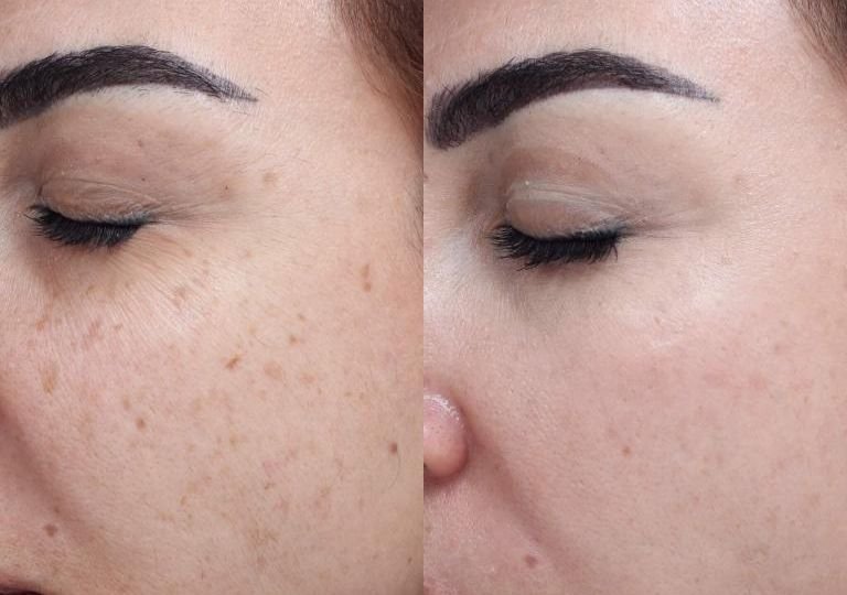 Treatment of brown spots with Vascular Laser