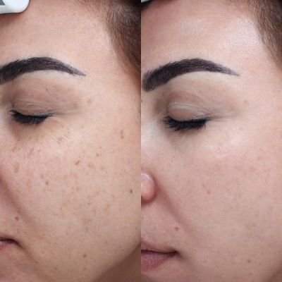 Treatment of brown spots with Vascular Laser