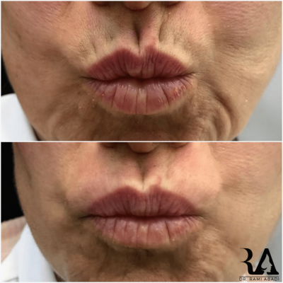 Fillers for Smoker Lines