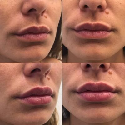 Lip Enhancement with Fillers