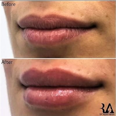 Lip Enhancement with Fillers