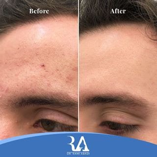 Acne Treatment