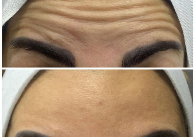 Botox for forehead lines and wrinkles