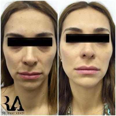 Fillers for Full Face
