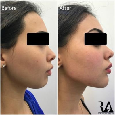 Chin Enhancement and Jawline Definition with Fillers