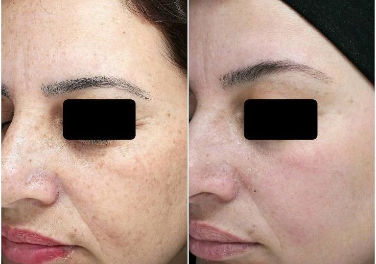 Treatment of freckles, pigmentation and skin texture