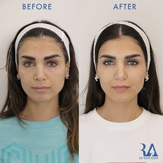 Fillers for Full Face