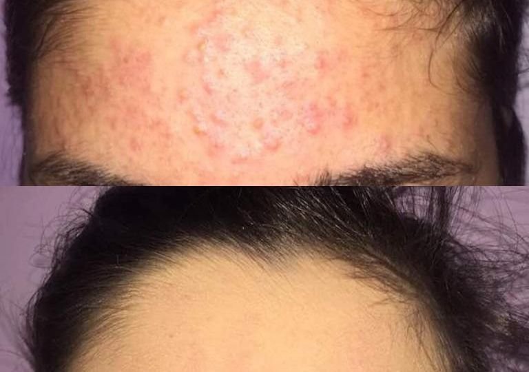 Acne Treatment