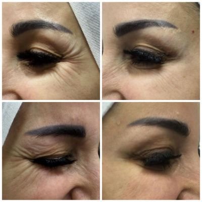 Botox for Crow's feet