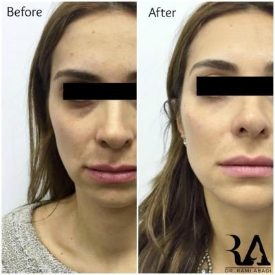 Fillers for Full Face