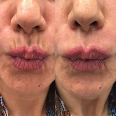 Fillers for Smoker Lines