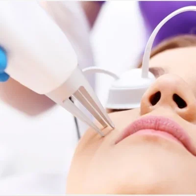 Acne Surgery