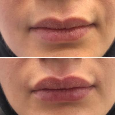 Lip Enhancement with Fillers