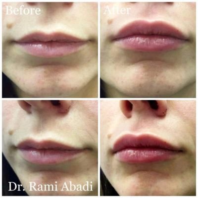 Lip Enhancement with Fillers