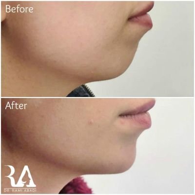 Chin Enhancement and Jawline Definition with Fillers