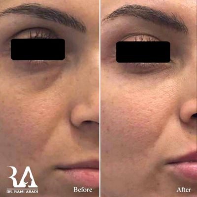 Fillers for under eyes