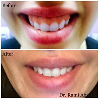 Botox for Gummy Smile