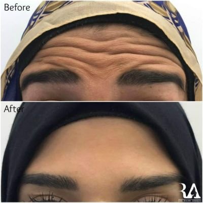 Botox for forehead lines and wrinkles