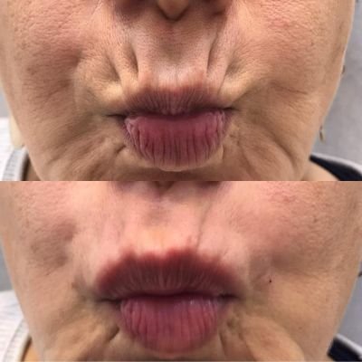 Fillers for Smoker Lines