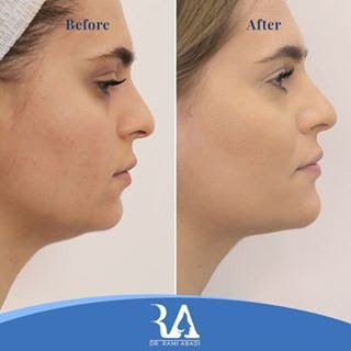 Chin Enhancement and Jawline Definition with Fillers