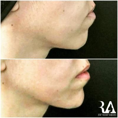 Chin Enhancement and Jawline Definition with Fillers