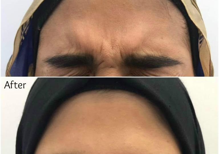 Botox for Frown Lines