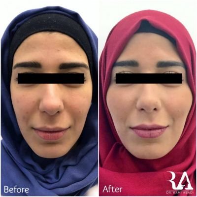 Fillers for Cheeks