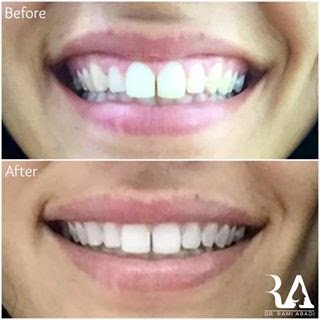 d0679-Before-and-After-Gummy-Smile-correction