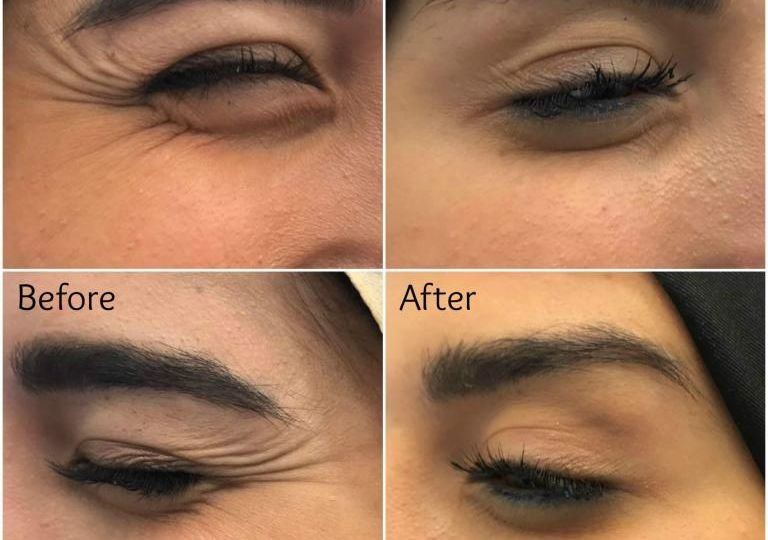 Botox for Crow's feet