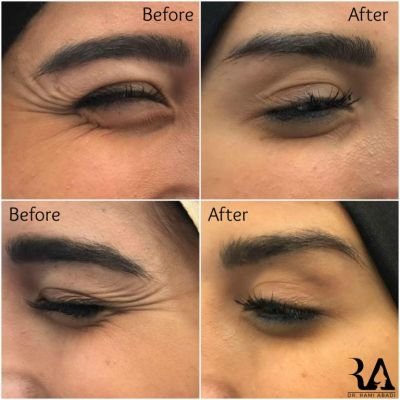 Botox for Crow's feet
