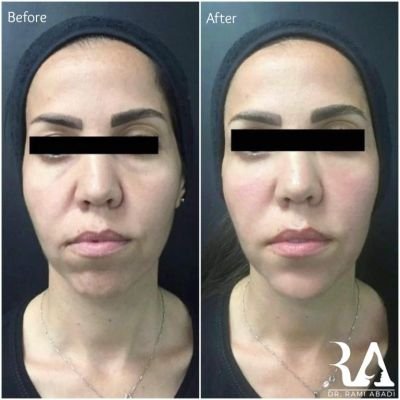 Fillers for Full Face