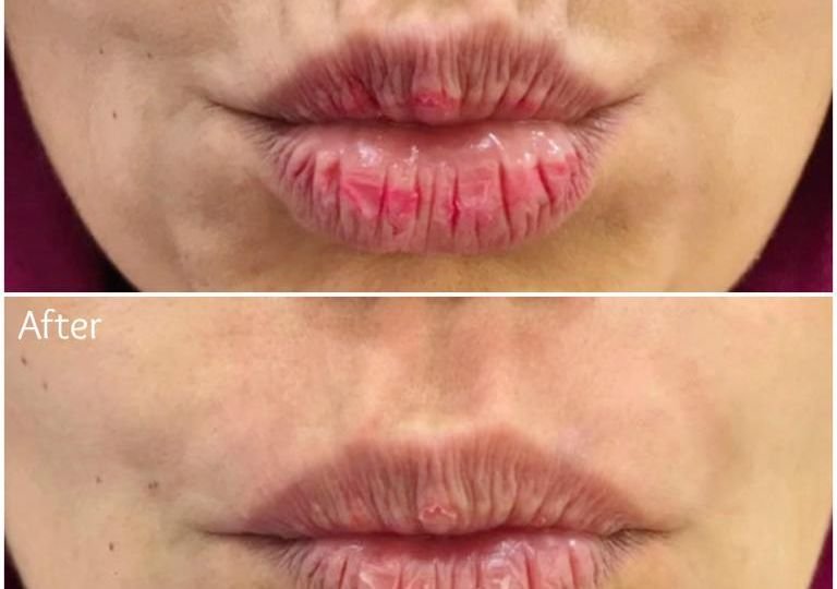 Fillers for Smoker Lines