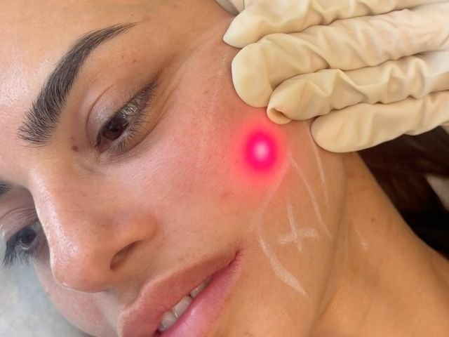 Experience the power of non-invasive transformation with Endolift. Lift, tighten and rejuvenate your skin, instantly!